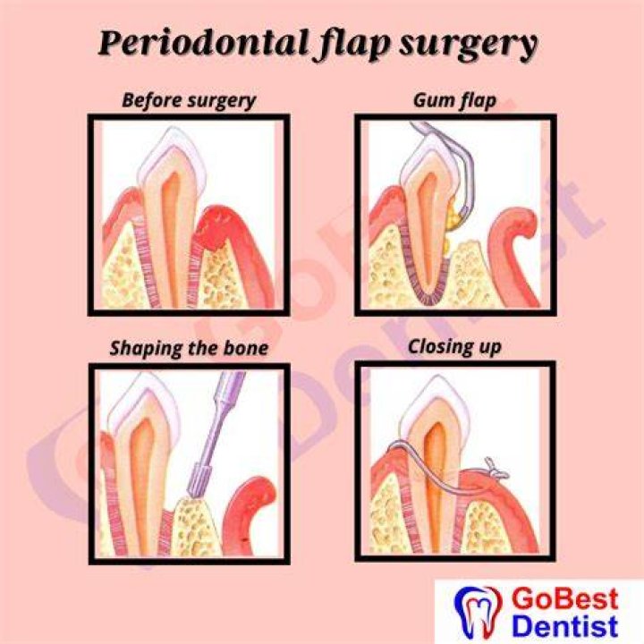 Flap your gums