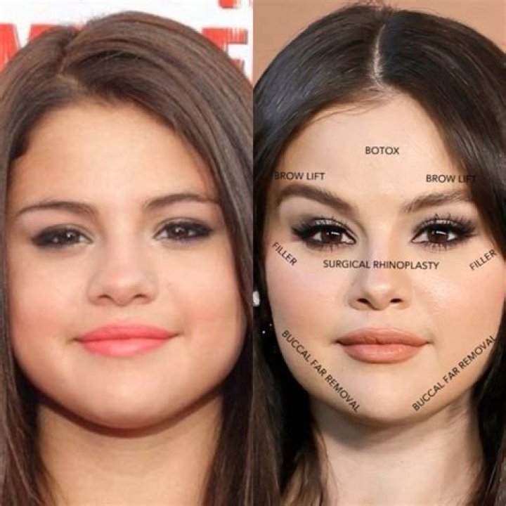 The Ultimate Guide To Selena Gomez's Face Surgery: Procedures, Results, And More
