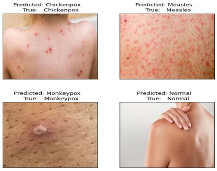 Tragic Loss: Immunocompromised Texan Succumbs To Monkeypox